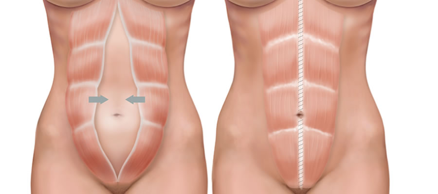 Veja como o pilates pode atuar no controle da Diástase